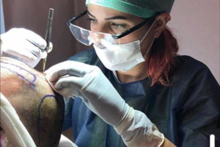 زراعة الشعر بدون حلاقة حصرياً في مركز Estepera 3 e7686ef124e21f65487feff30fcd93f9