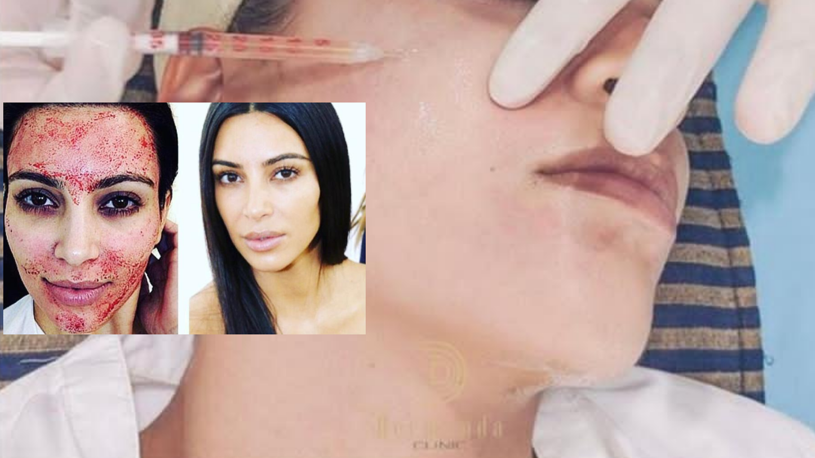  Dermand Clinic تقدم تقنية الـ"PRP" بجودة عالية واهتمامٍ لا مثيل له 3 78f41efb9621fbbd085d733fe253d135