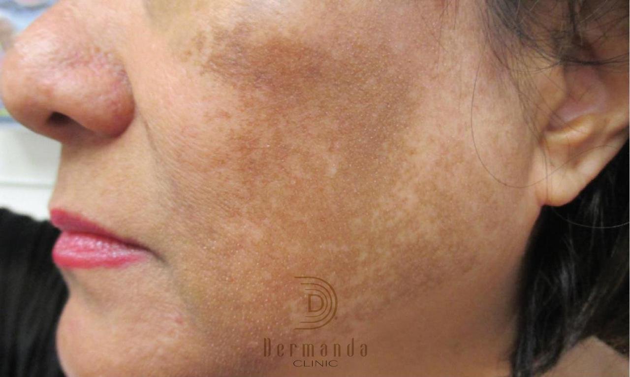Dermanda Clinic المركز الأول لعلاج الكلف في لندن 3 10e23c63c370afb647792dd7395d019a