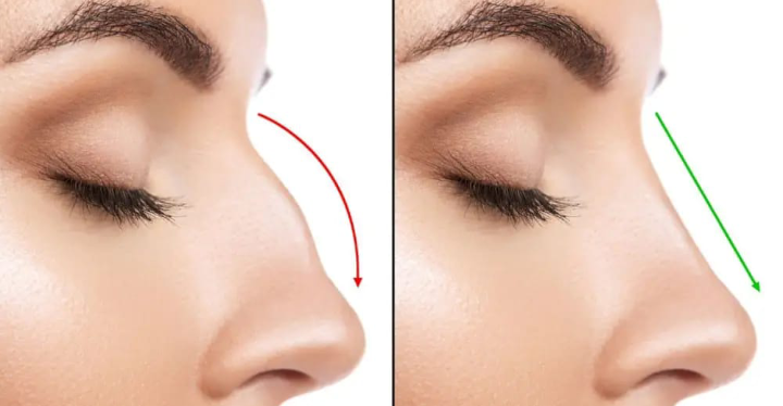 عمليات تجميل الأنف... مع دكتور التجميل علي عبد علي 1 5f18b369e733ac7412fd815845585c2e