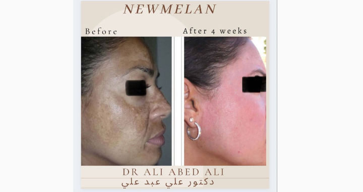 دكتور التجميل علي عبد علي يتحدث عن تقنية "Newmelan Pigmentation" 1 be2b4c89438099e8fca78e767ef03dbd