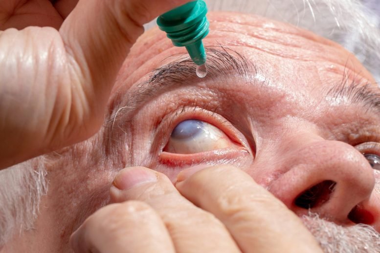 تم تحديد الجزيئات الطبيعية كسلاح جديد محتمل ضد الجلوكوما 3 مرض العين الجلوكوما