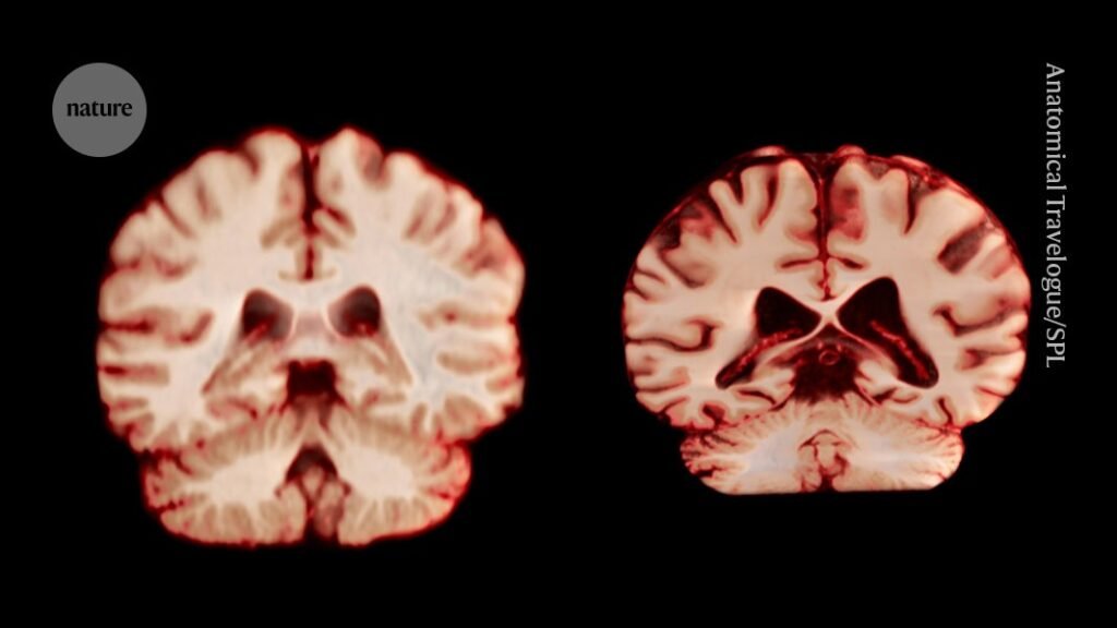 ماذا يعني ذلك بالنسبة لمرض الزهايمر