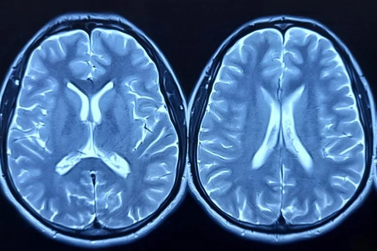Comparison MRI Brain Scans