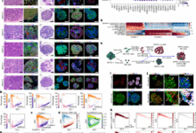 NSD2 targeting reverses plasticity and drug resistance in prostate cancer