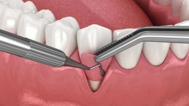 تحسين زراعة وترميم الأسنان بإنجاز نانوي إيراني