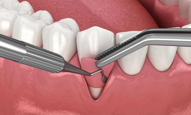 تحسين زراعة وترميم الأسنان بإنجاز نانوي إيراني