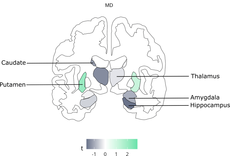 30.000 عملية مسح للدماغ تكشف عن خطر خفي في الأطعمة فائقة المعالجة 2 Brain Regions Associated With High Consumption of Ultra Processed Foods