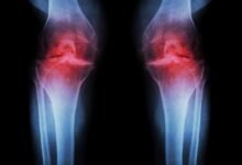 Osteoarthritis Knee