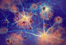 Amyloid Plaques Neurons Alzheimer