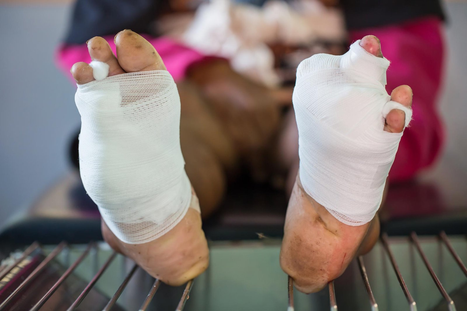 ما يكمن في جروح القدم السكرية قد يفسر فشل العلاج